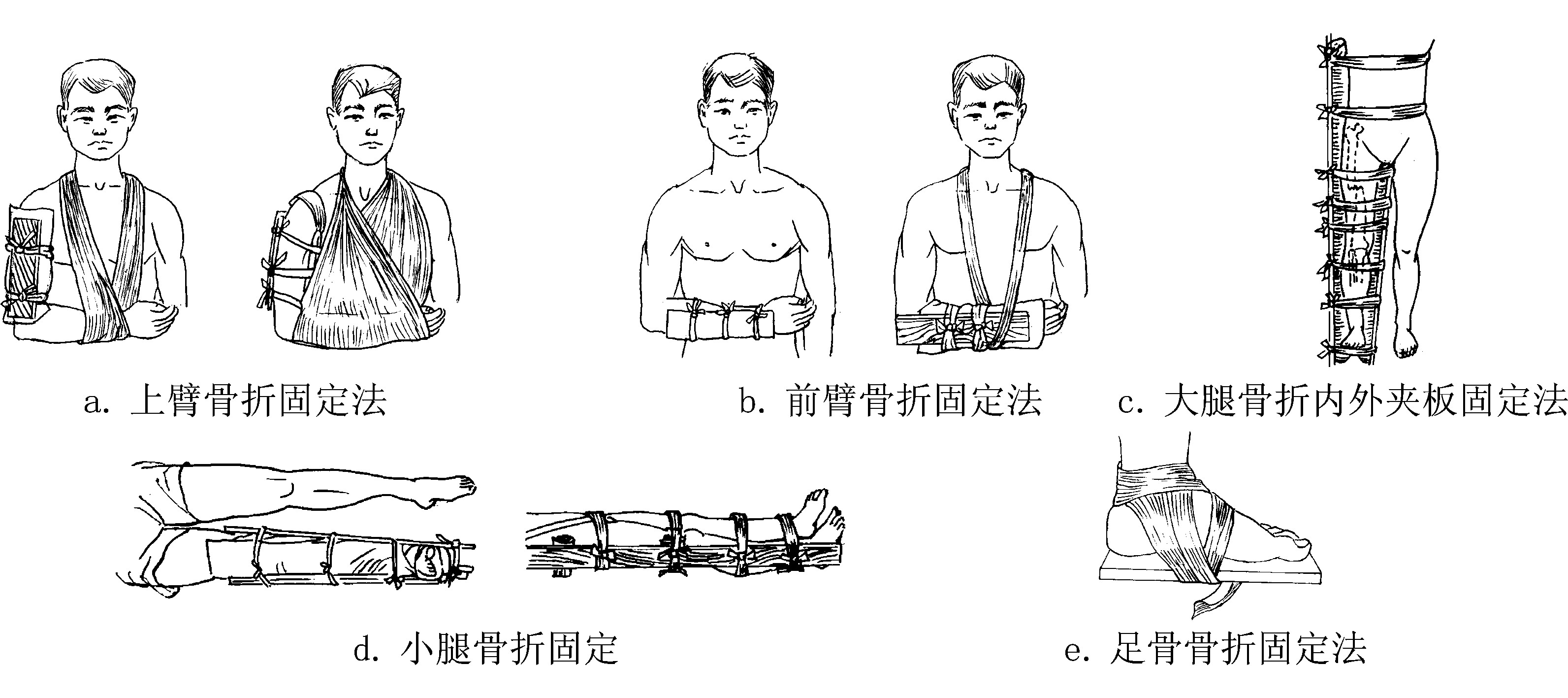 如何正确为家人进行骨折固定处理？